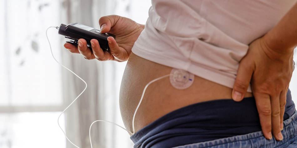 A pregnant woman uses an insulin pump.
